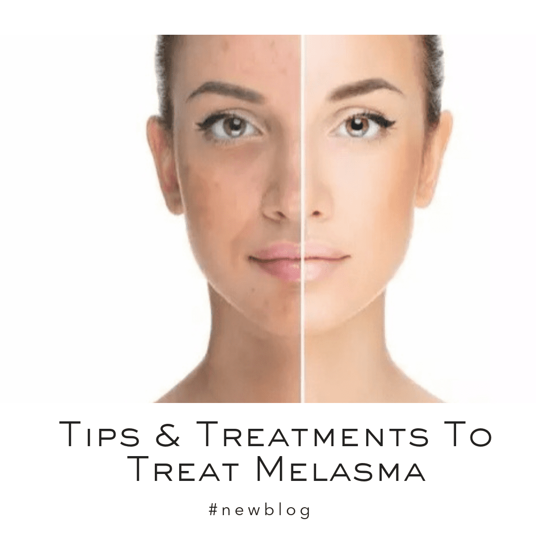Tips And Treatments For Melasma | Dr. Geetika helps you treat pigmentation I Post Pregnancy Special