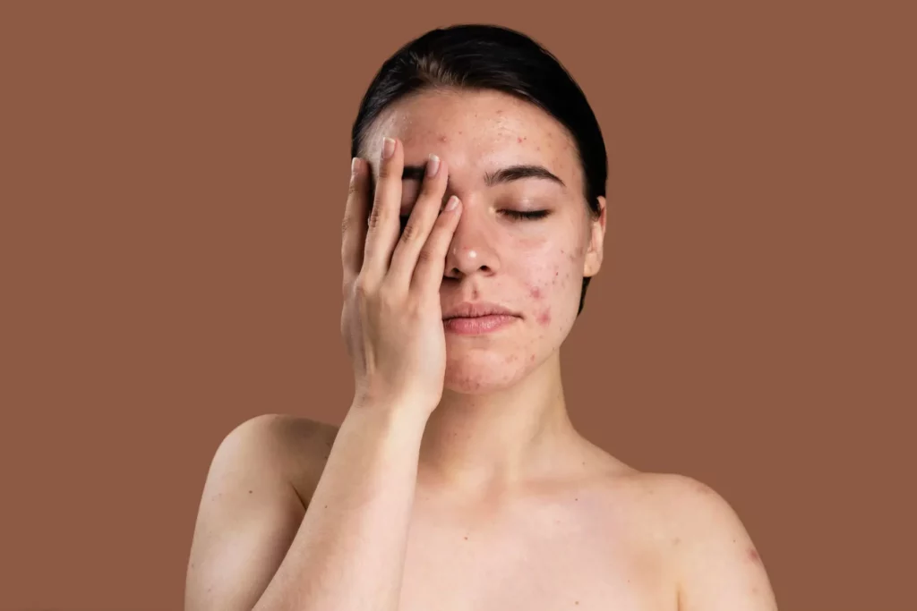 Types Of Acne and treatment
