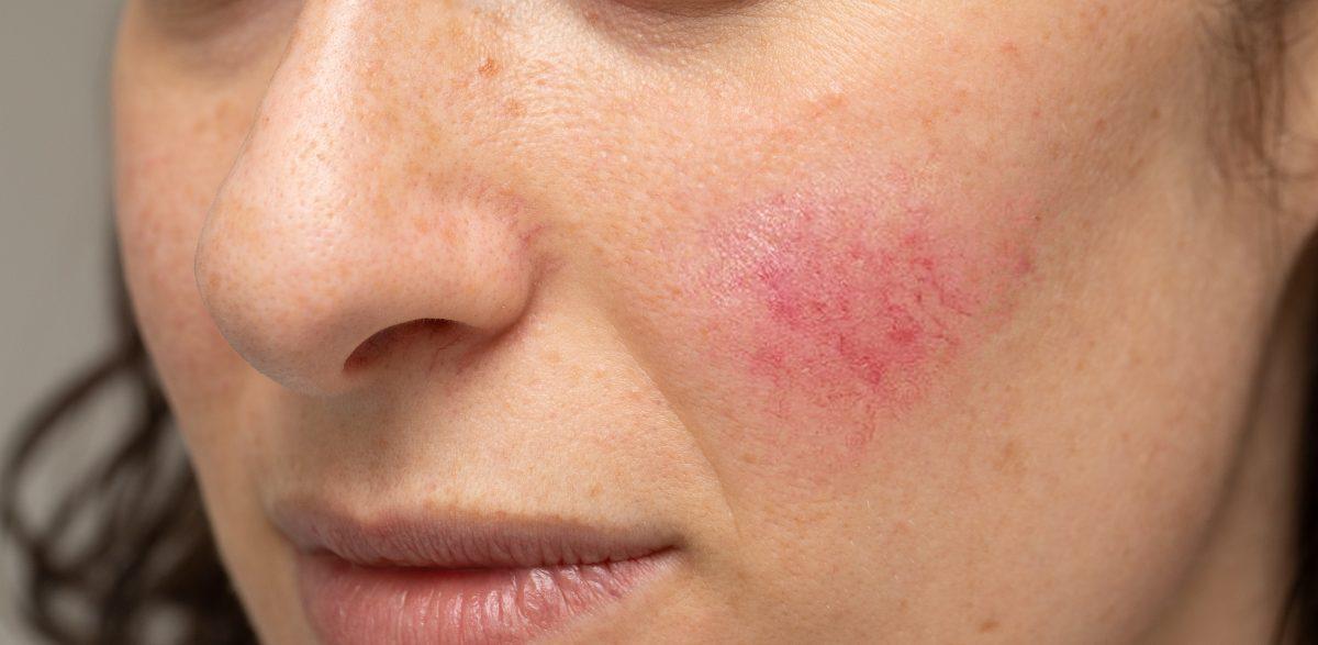 Acne Rosacea