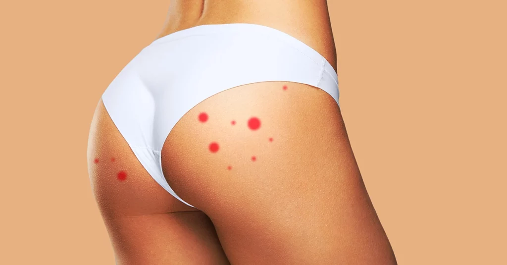 Have Pimples on Buttocks