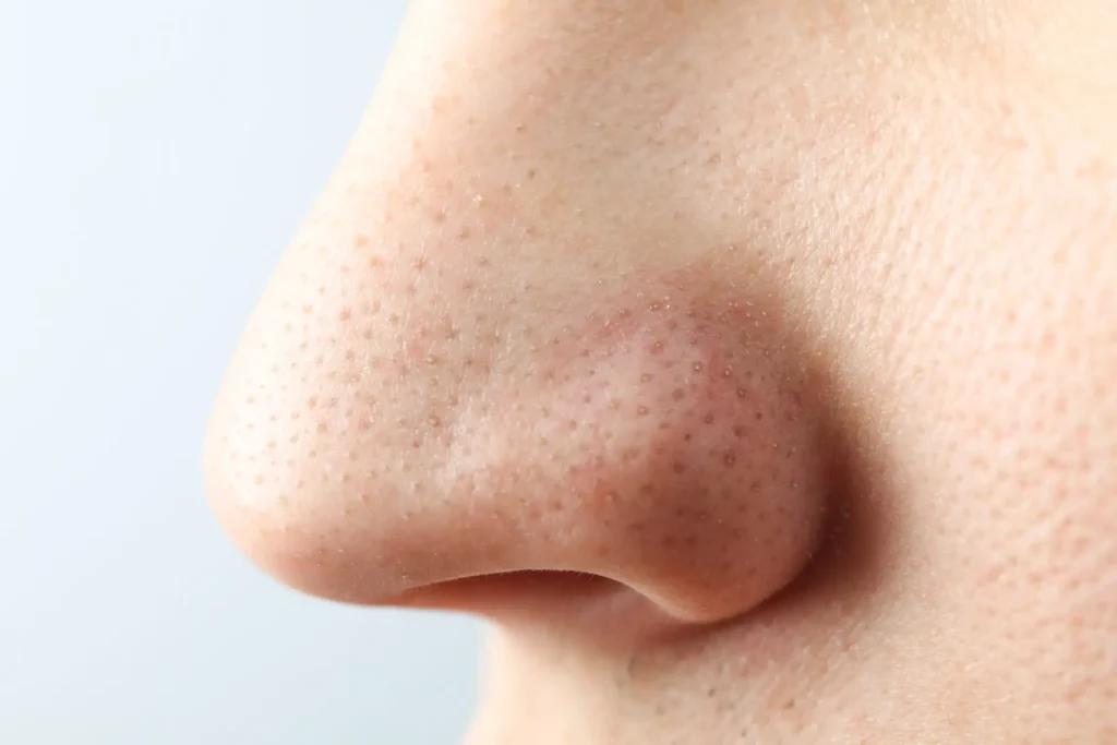 What-are-blackheads