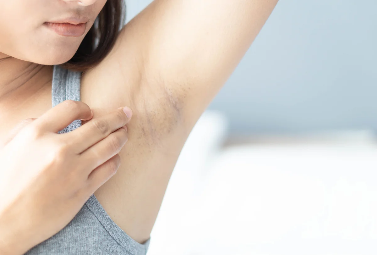 Treat Dark Underarms