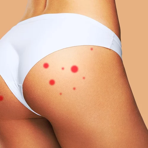  <strong>Have Pimples on Buttocks? Combat It With These Steps</strong>