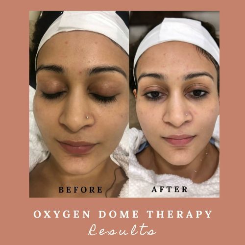 There’s A New Korean Facial In Town: Oxygen Dome Therapy