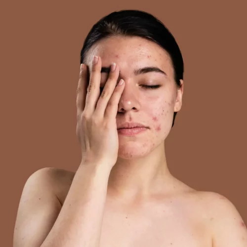 <strong>The Different Types Of Acne And How To Treat Them</strong>