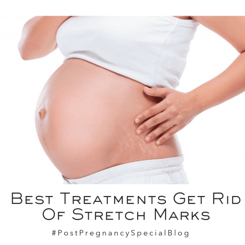 Best Treatments To Get Rid Of Stretch Marks | Laser Treatment For Stretch Marks | Types Of Stretch Marks | Dr. Geetika Mittal Gupta Gives You Tips On Stretch Marks